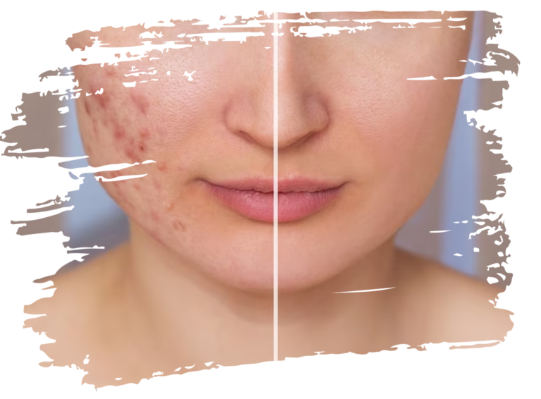 Acne care and treatment by dr ardra in visakhaptnam