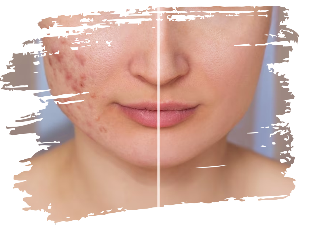 Acne care and treatment by dr ardra in visakhaptnam